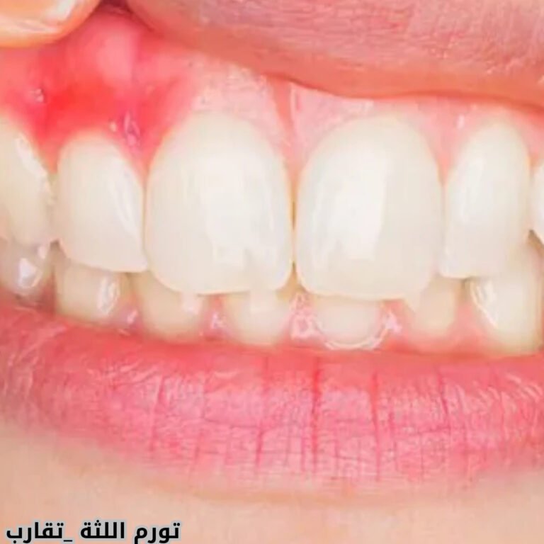 اكتشف أحدث أسباب تورم اللثة في 2024